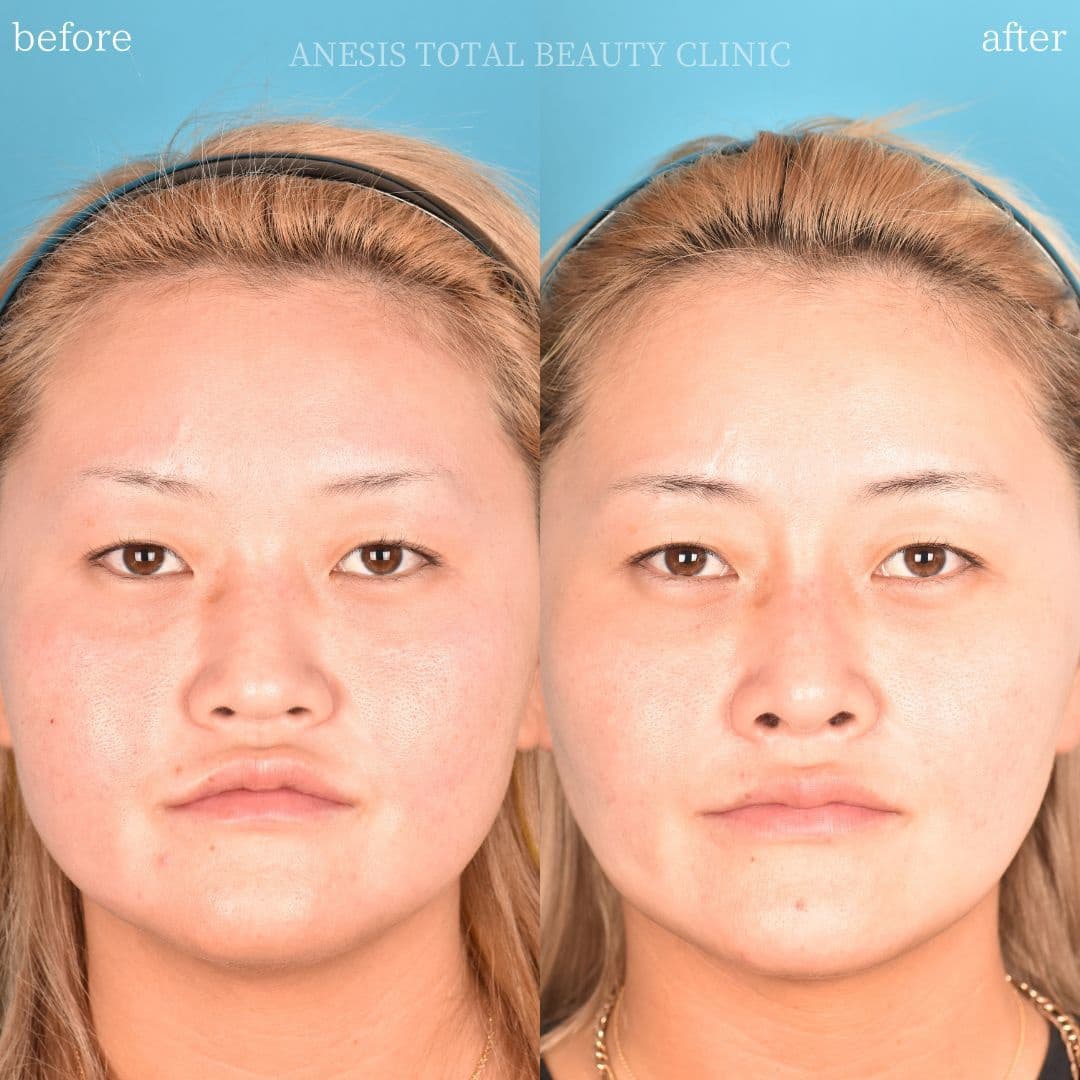 鼻整形ビフォーアフター