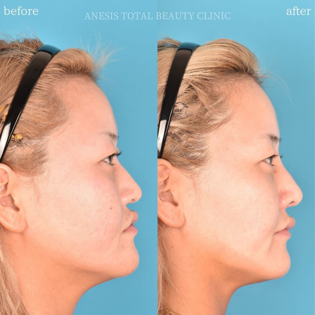 鼻整形ビフォーアフター