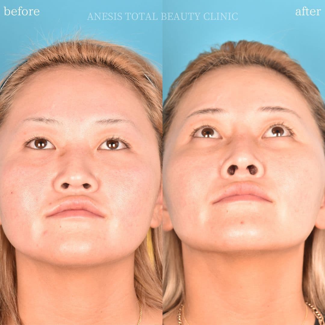 鼻整形ビフォーアフター