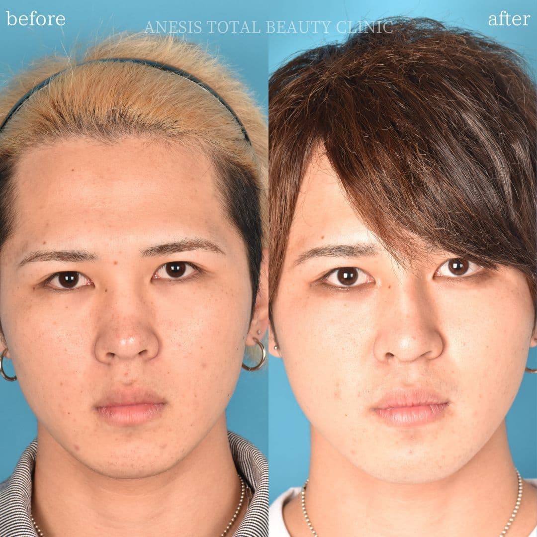 鼻整形ビフォーアフター