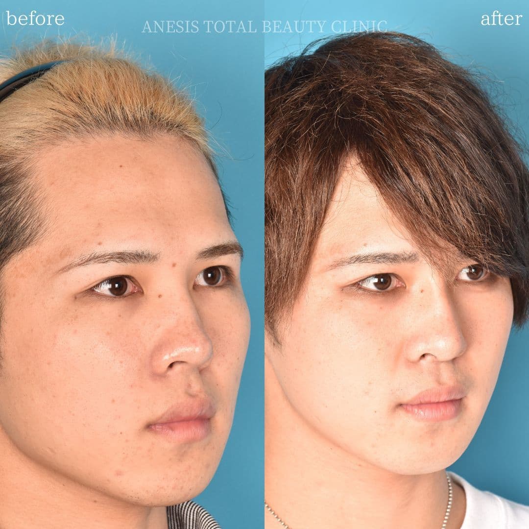 鼻整形ビフォーアフター
