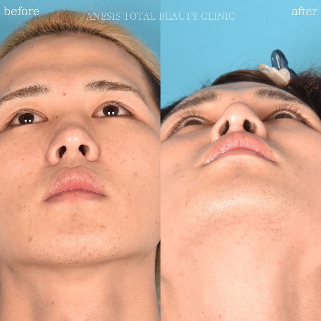 鼻整形ビフォーアフター