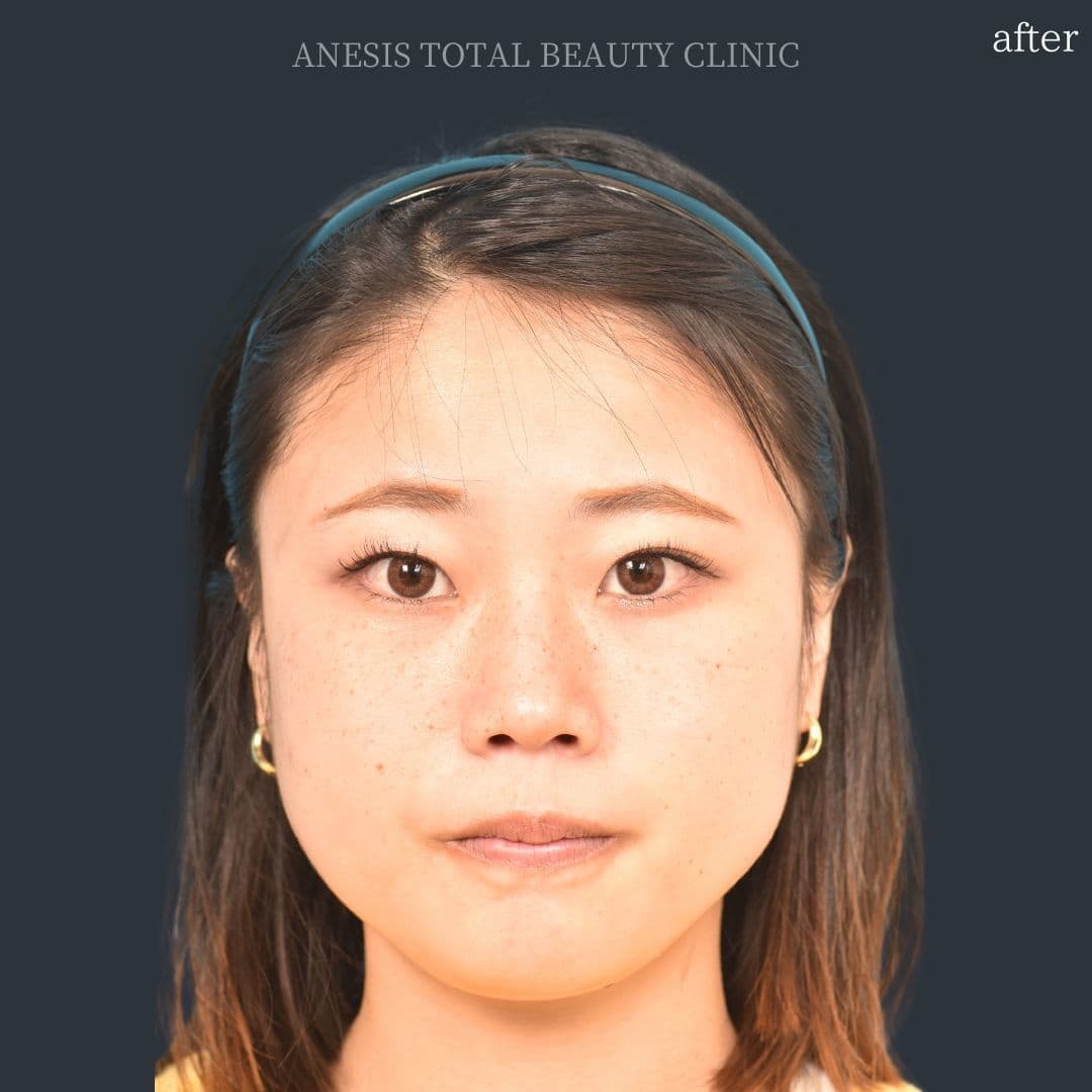 骨切りアフター