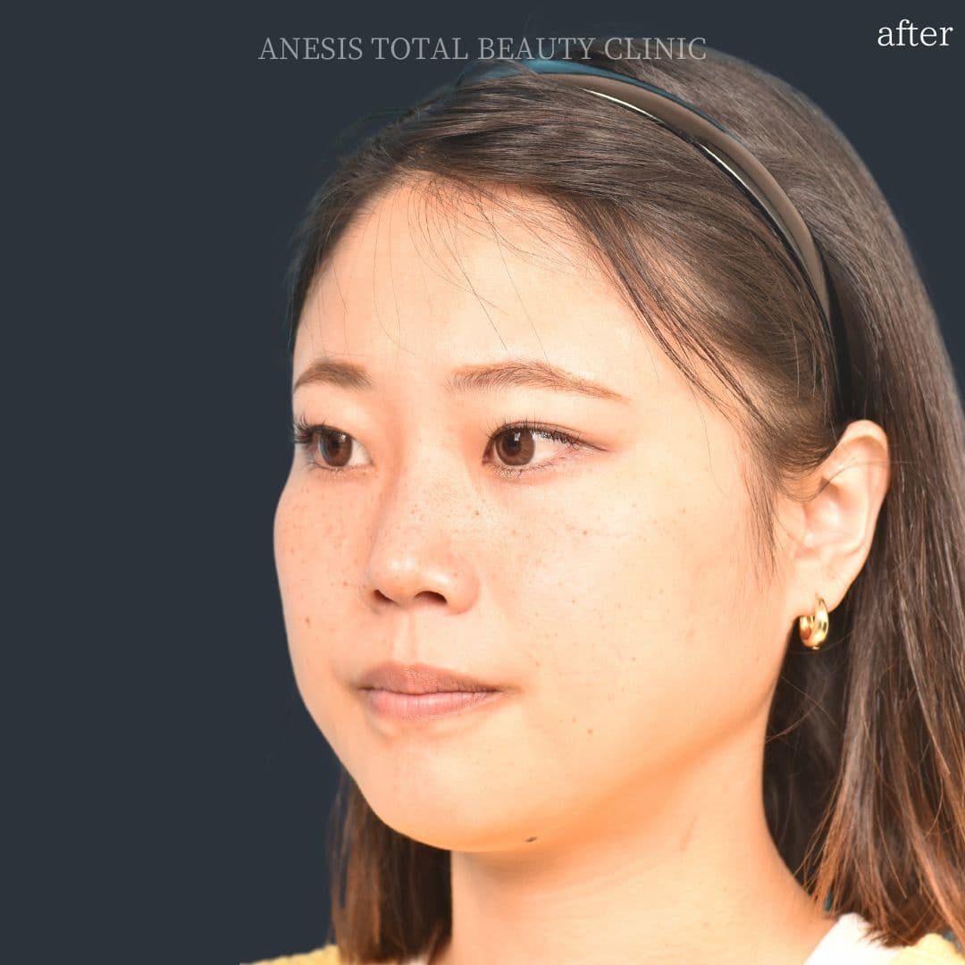 骨切りアフター