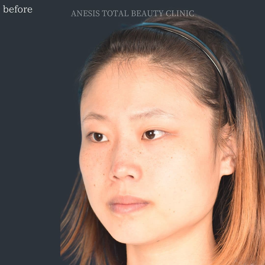 骨切りビフォー