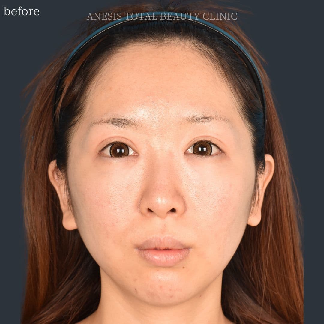 骨切りビフォー