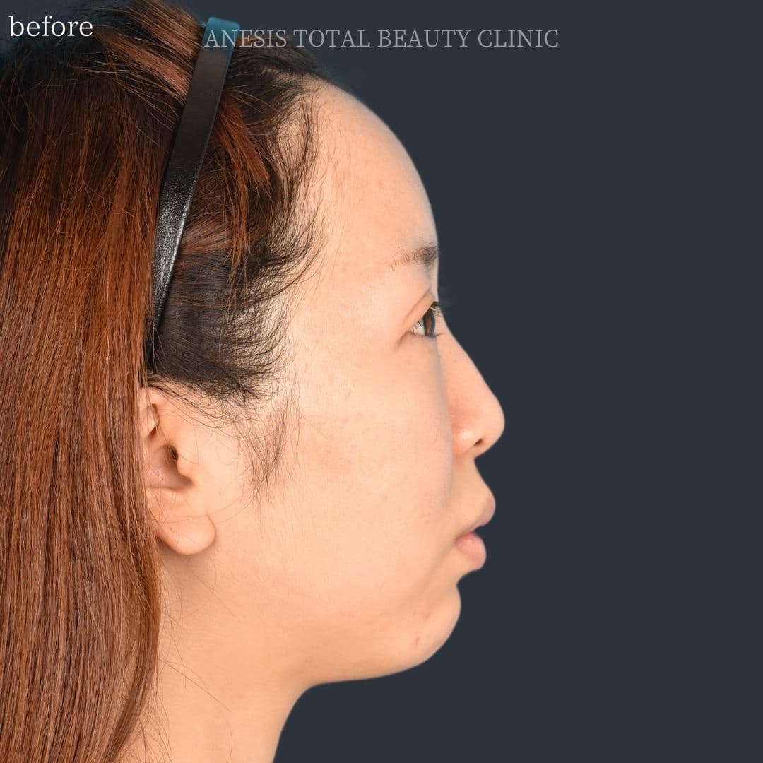 骨切りビフォー