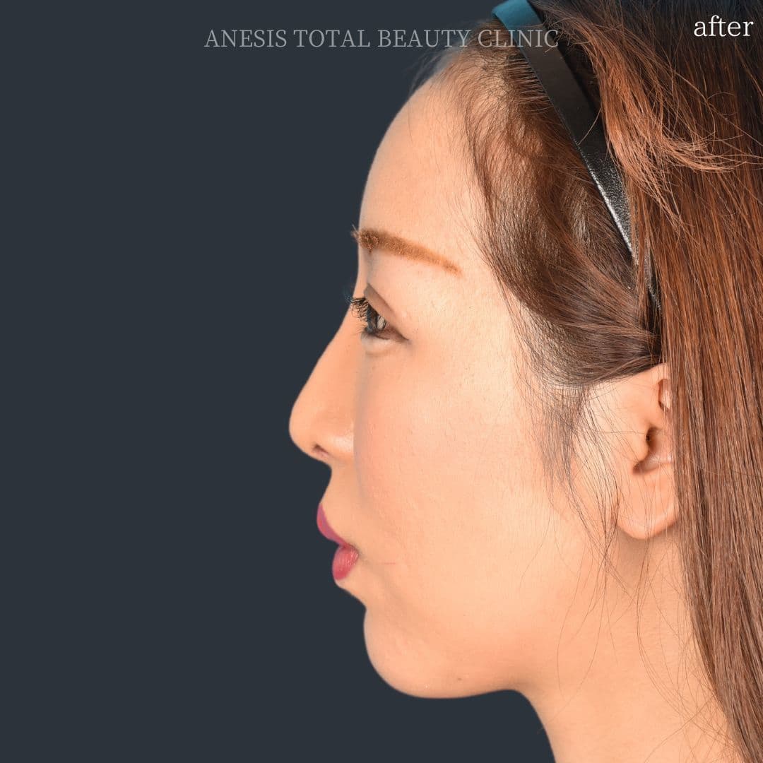 骨切りアフター