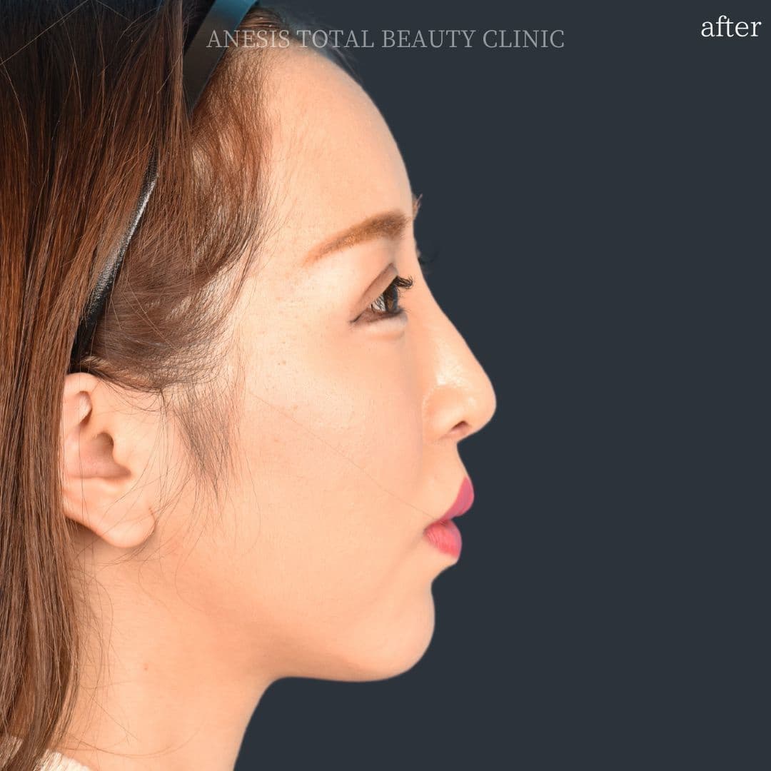 骨切りアフター