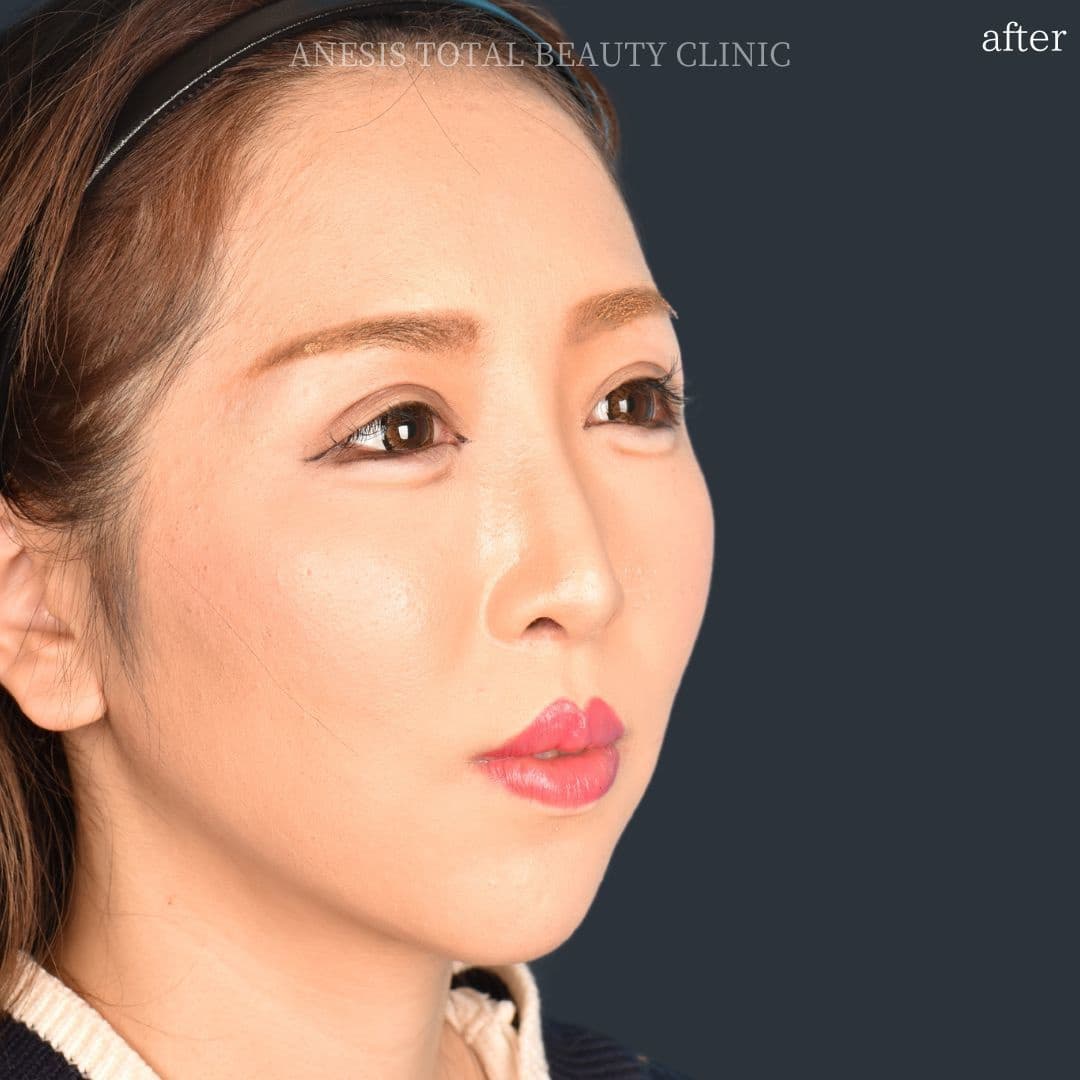 骨切りアフター