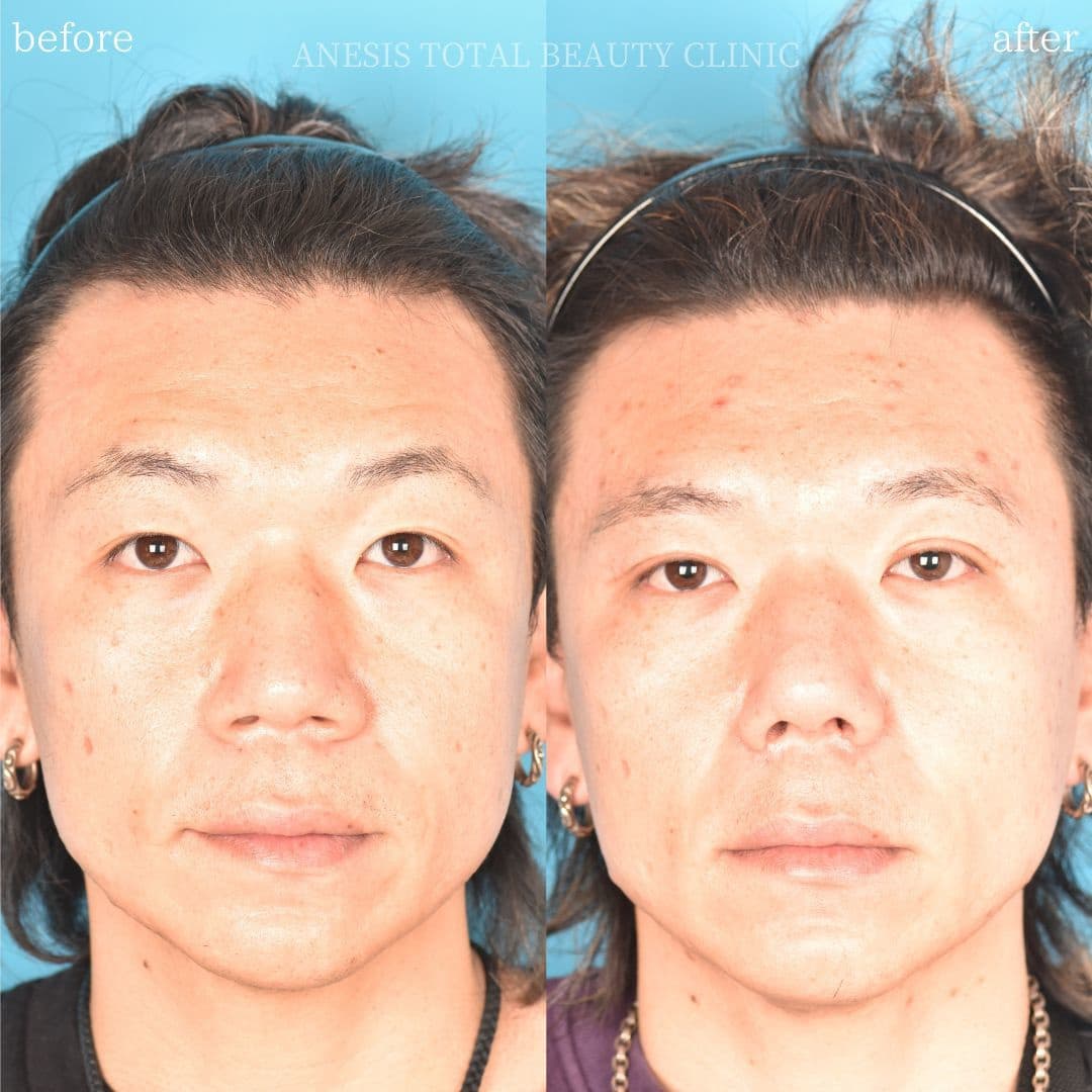 鼻整形ビフォーアフター