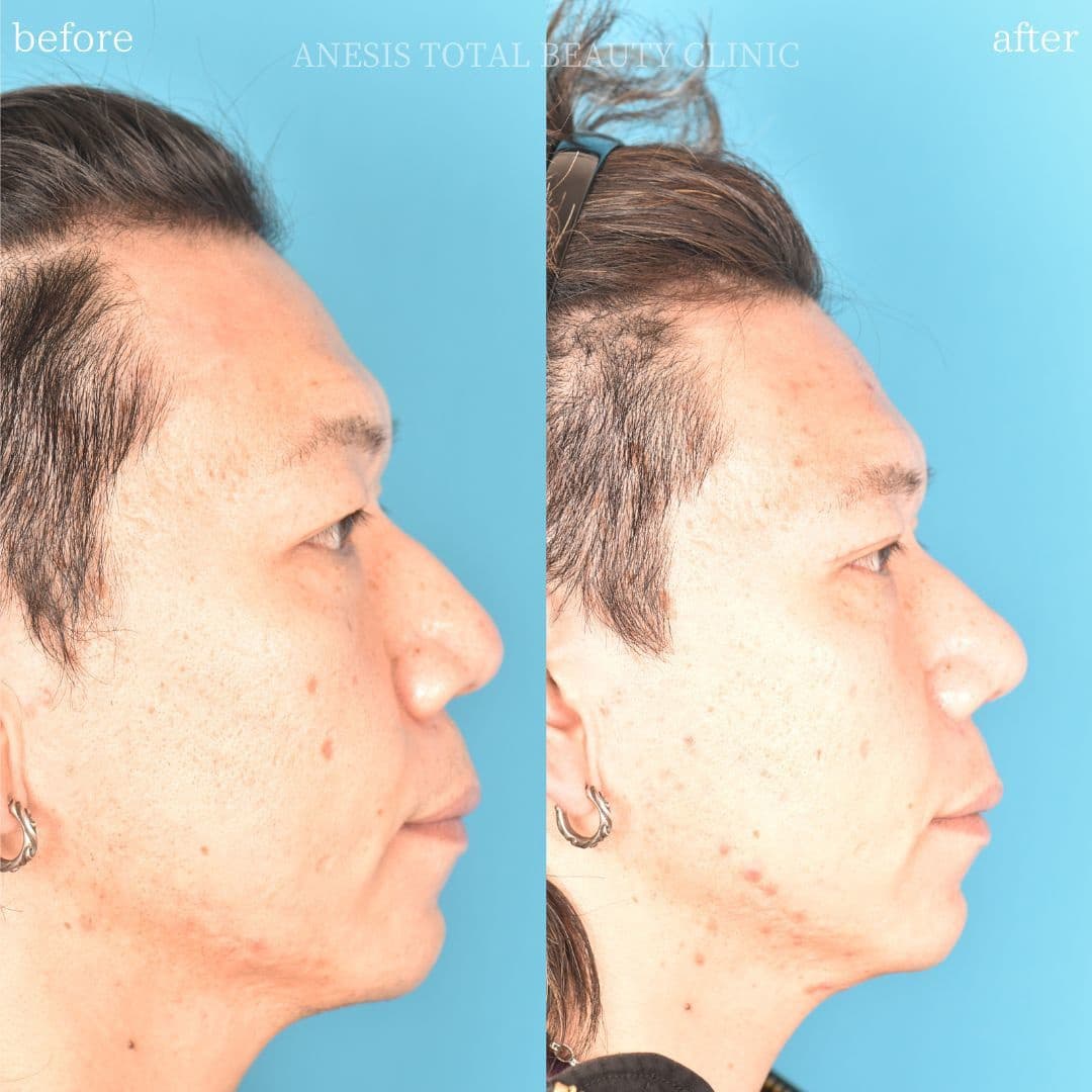 鼻整形ビフォーアフター