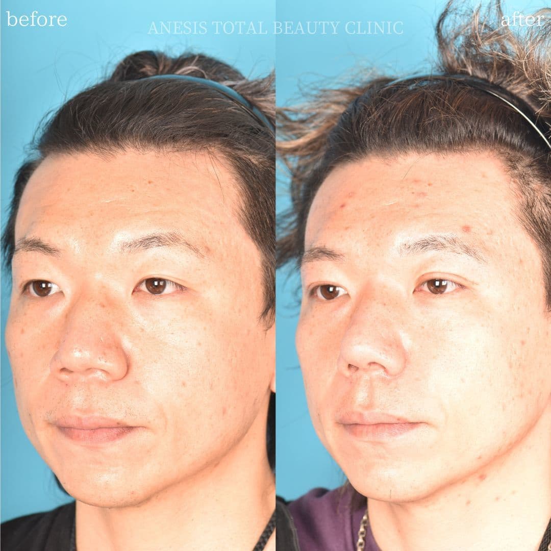 鼻整形ビフォーアフター