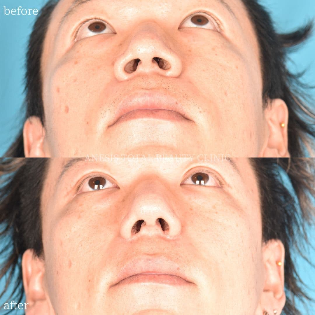 鼻整形ビフォーアフター