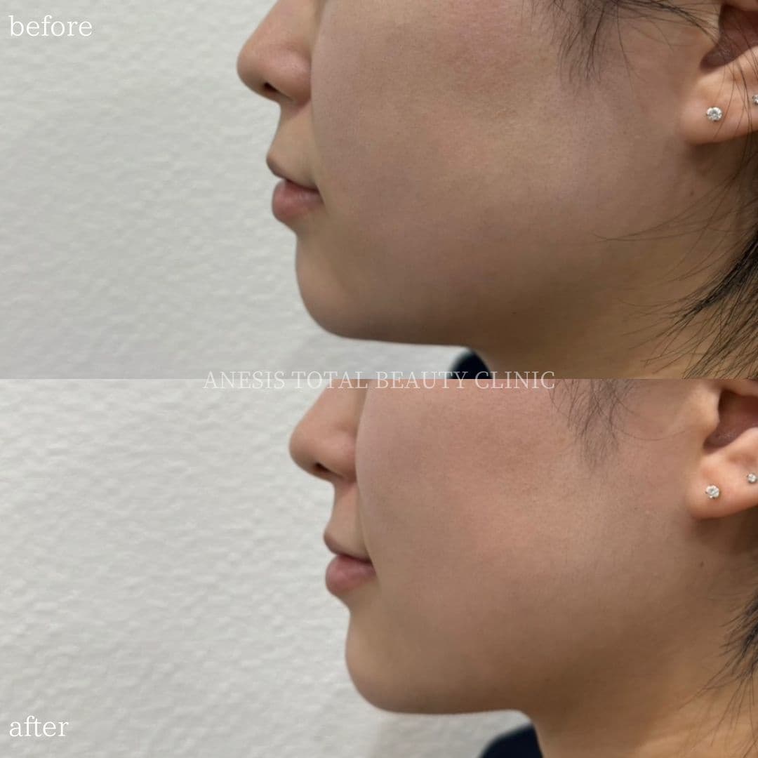 あごヒアルロン酸ビフォーアフター