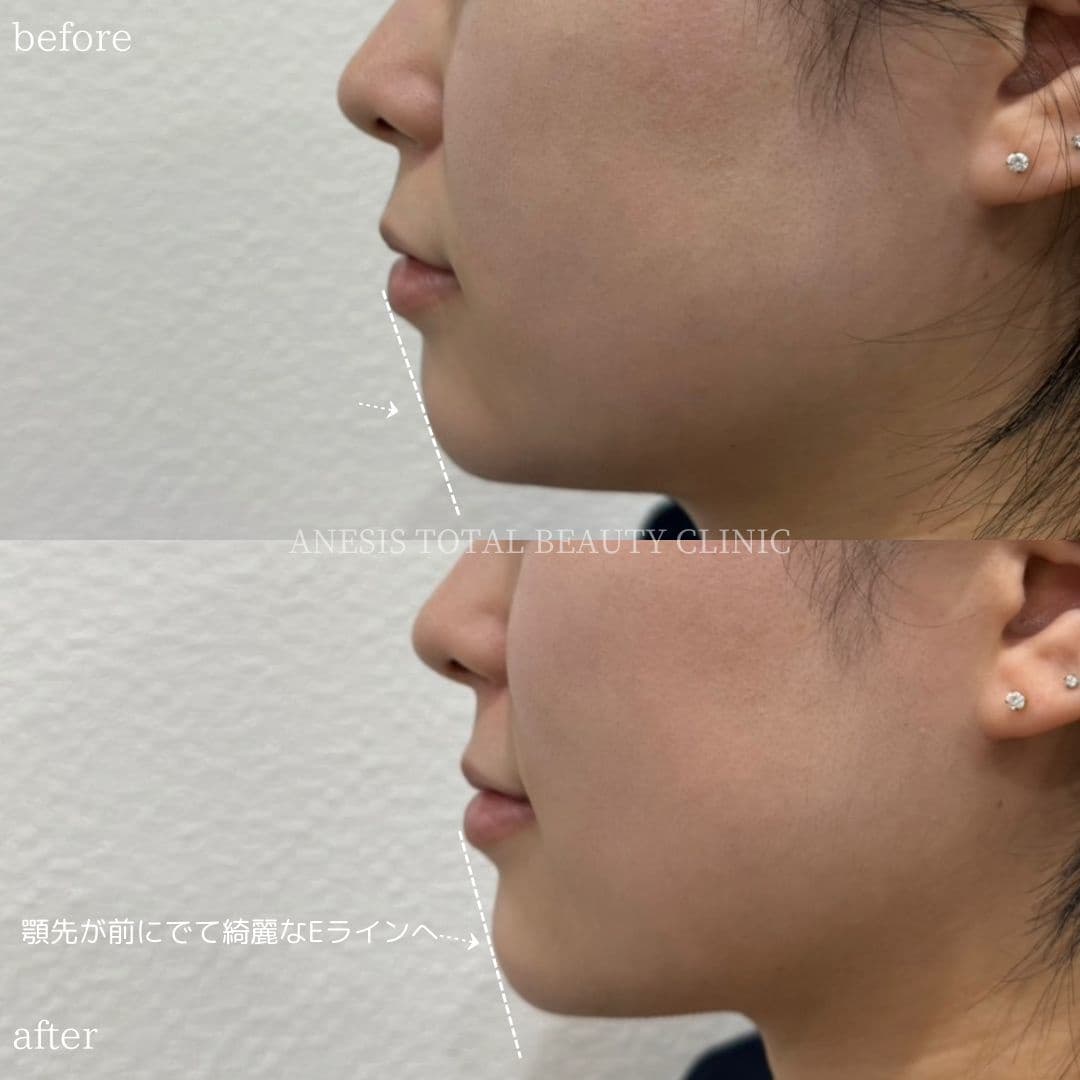 あごヒアルロン酸ビフォーアフター