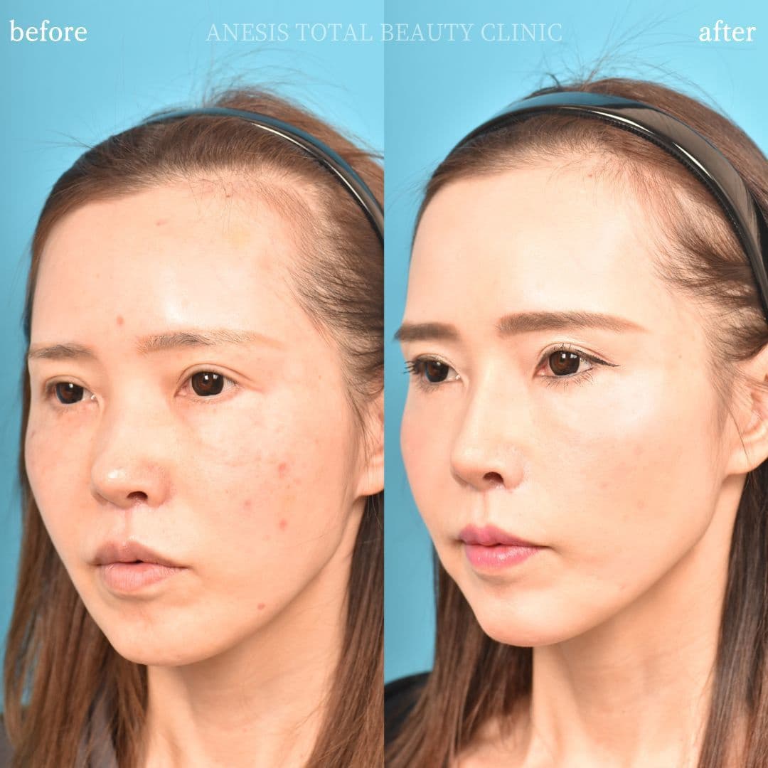 鼻プロテーゼビフォーアフター