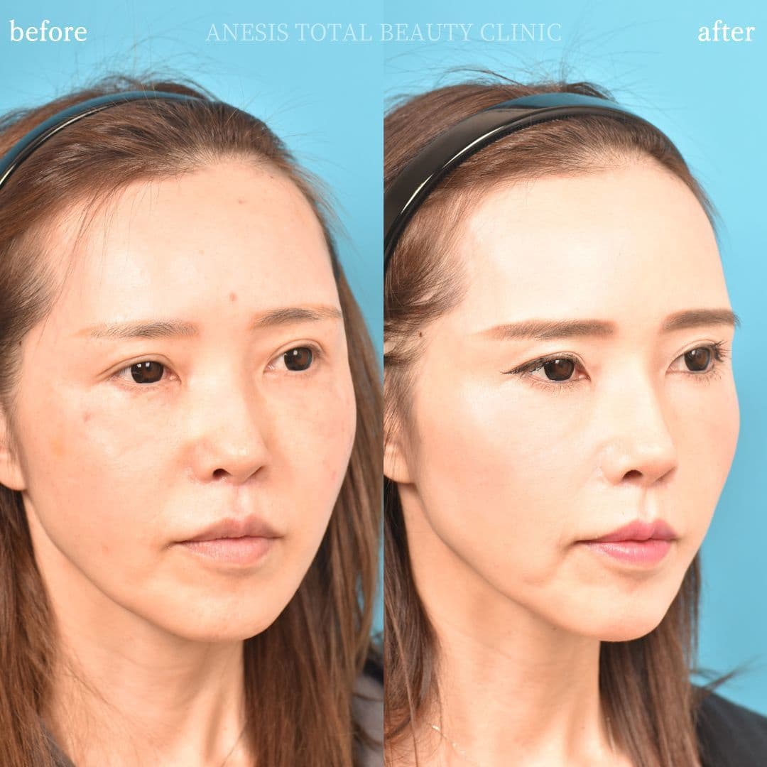 鼻プロテーゼビフォーアフター