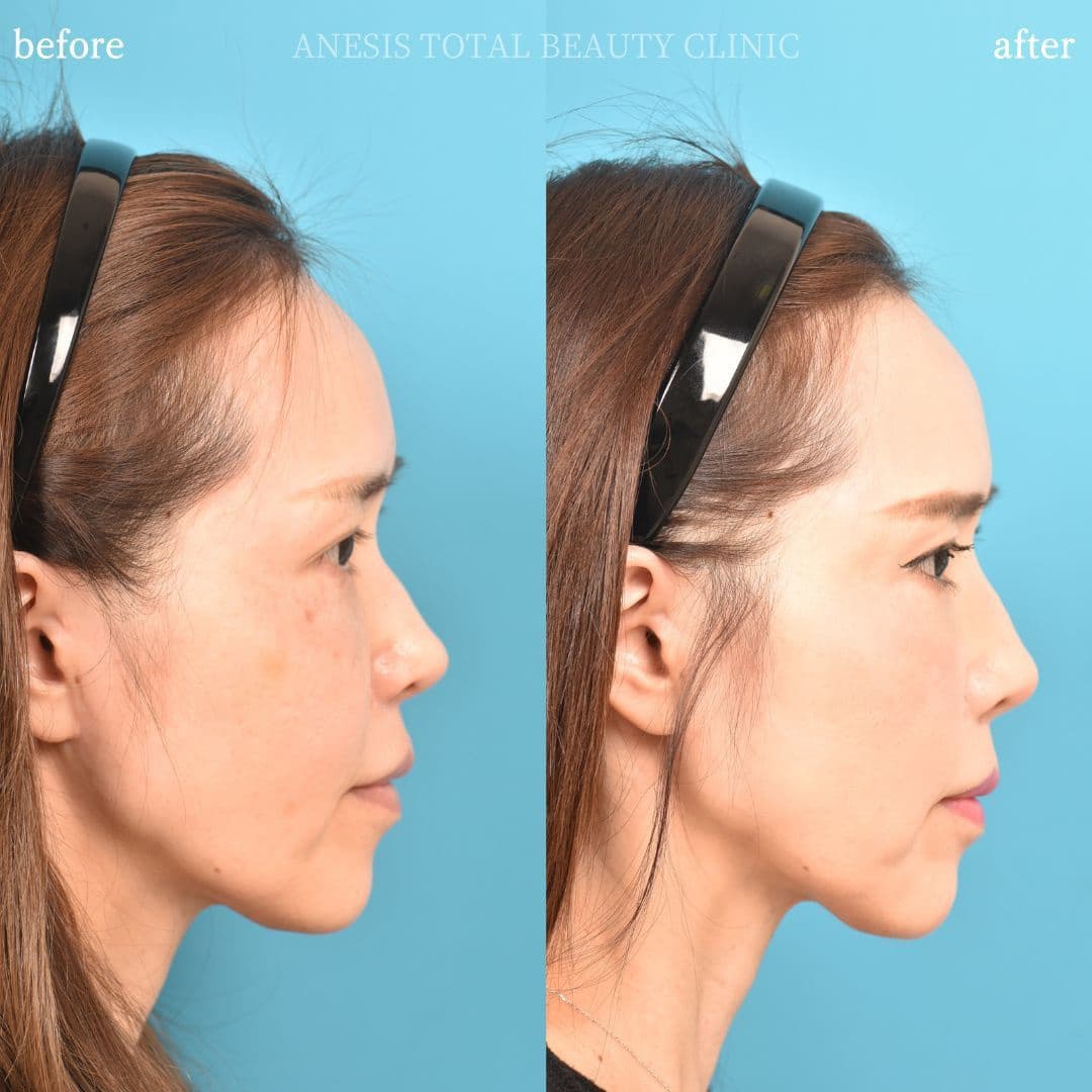 鼻プロテーゼビフォーアフター