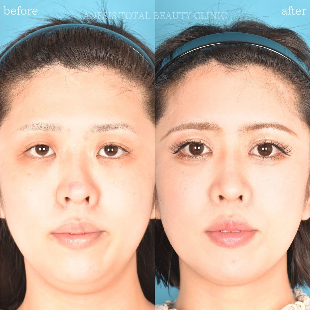 鼻整形ビフォーアフター