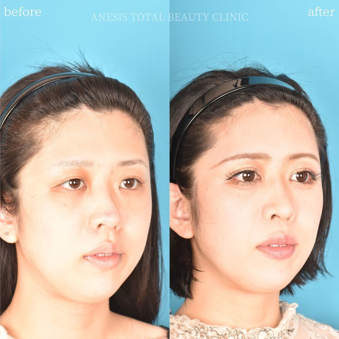 鼻整形ビフォーアフター