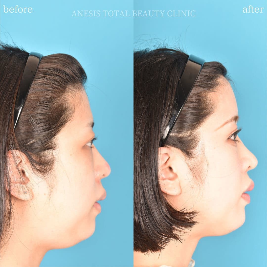 鼻整形ビフォーアフター