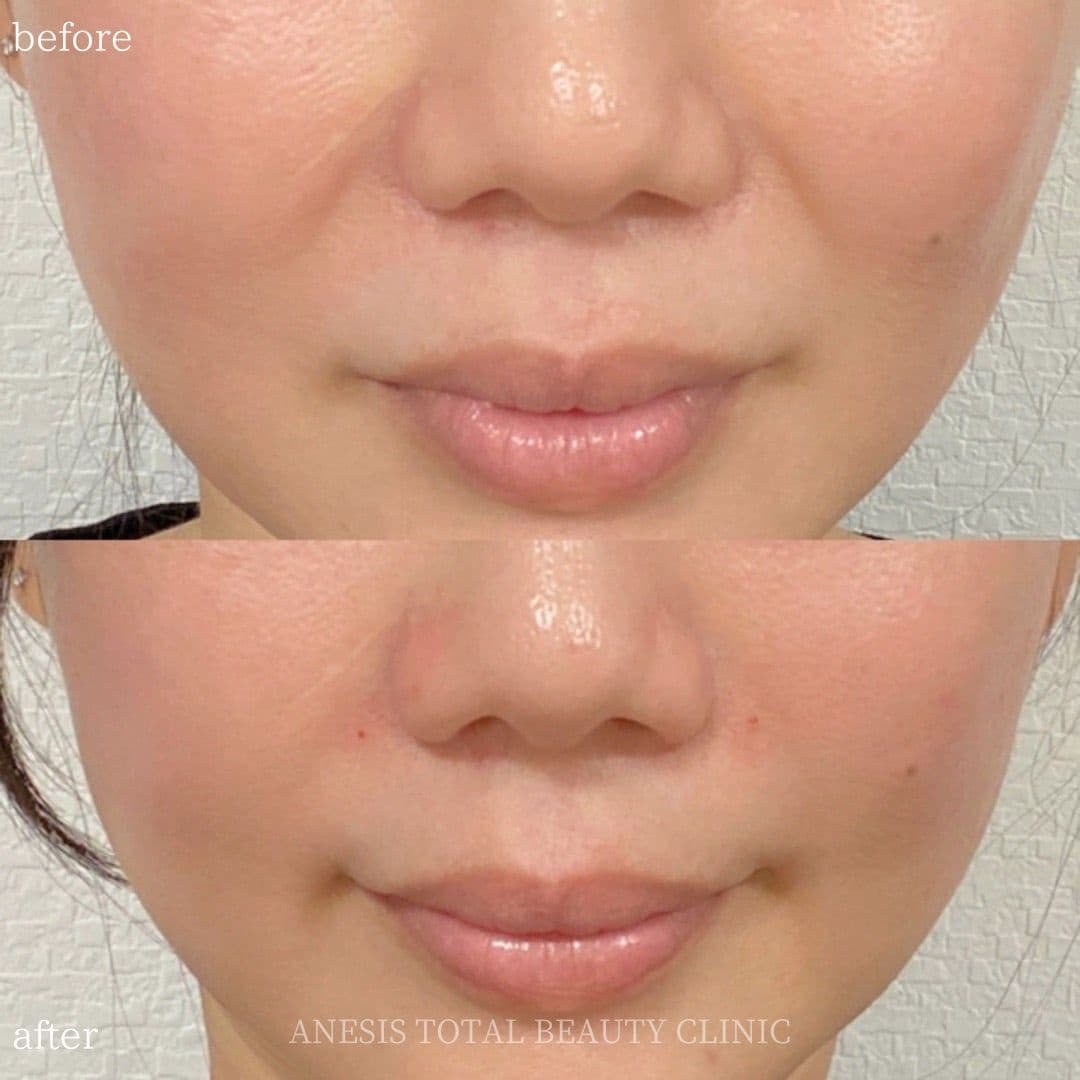 貴族フィラービフォーアフター