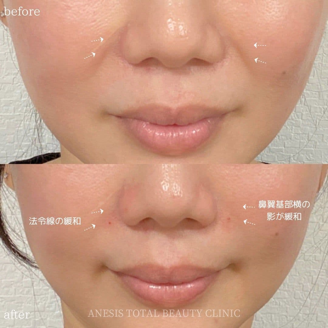 貴族フィラービフォーアフター