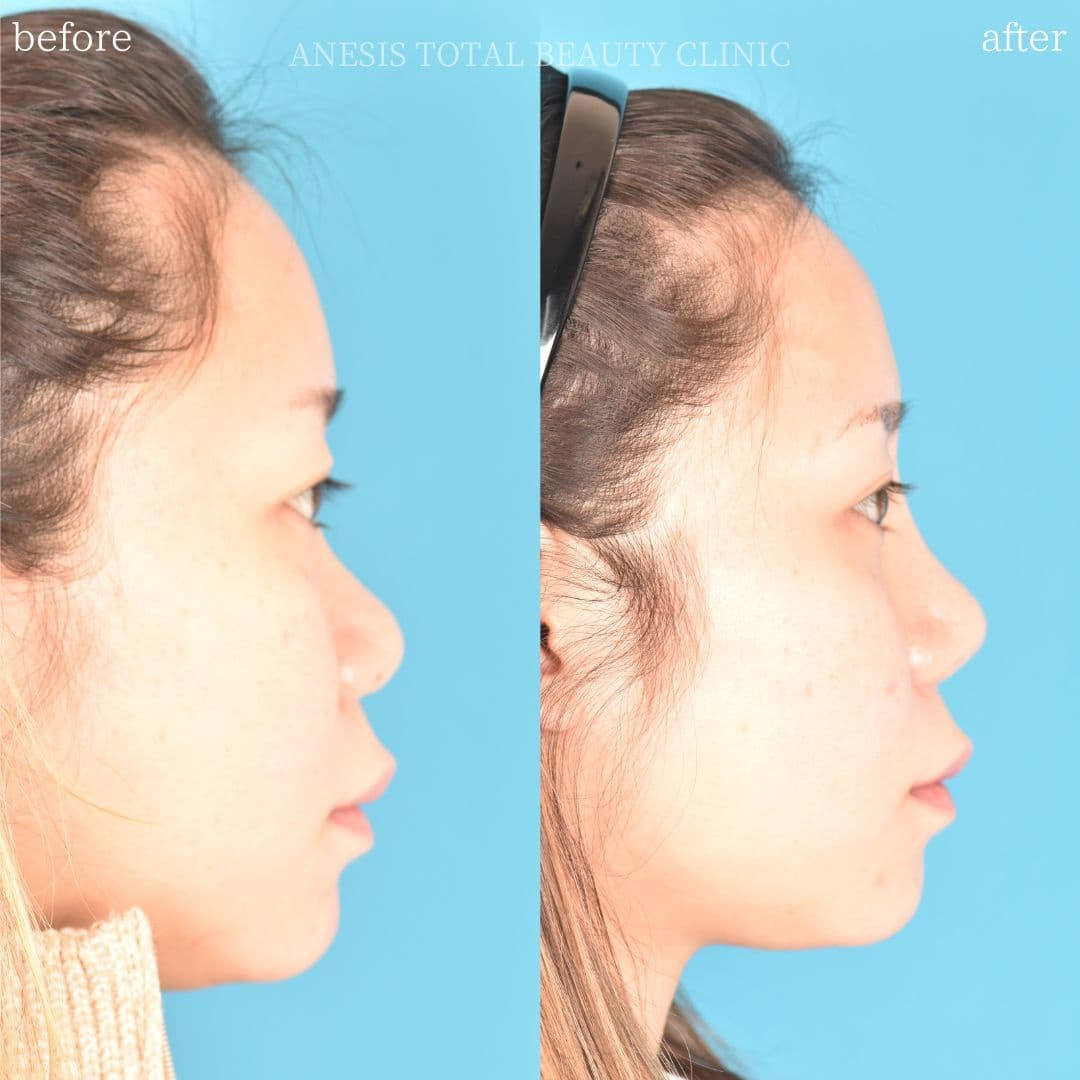 鼻整形ビフォーアフター