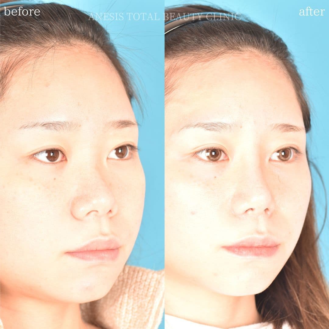 鼻整形ビフォーアフター