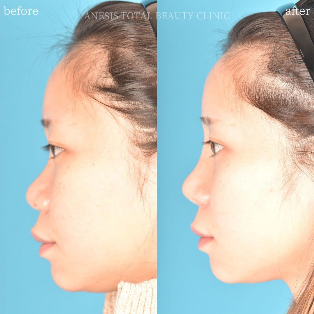 鼻整形ビフォーアフター