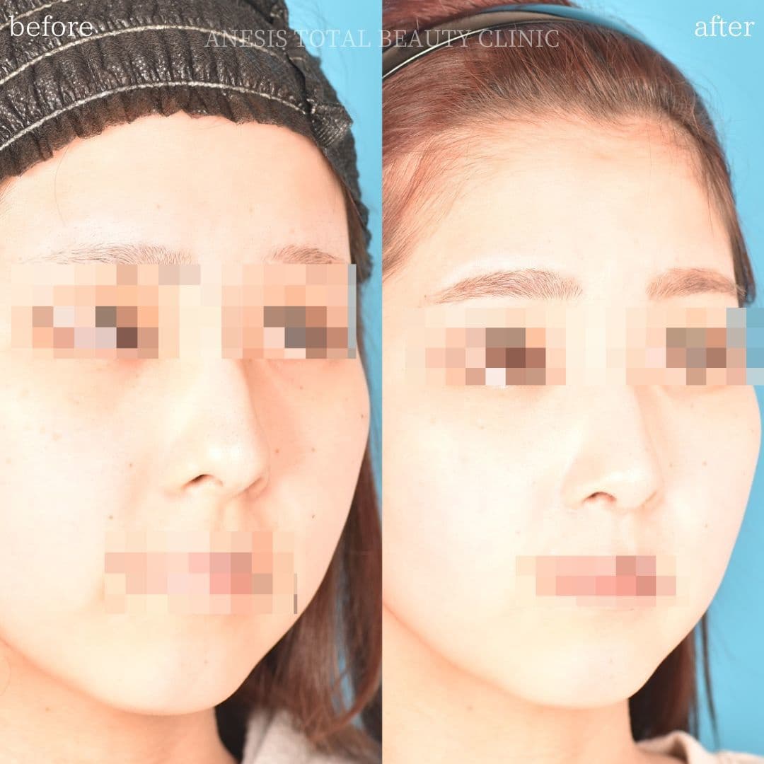 鼻整形ビフォーアフター