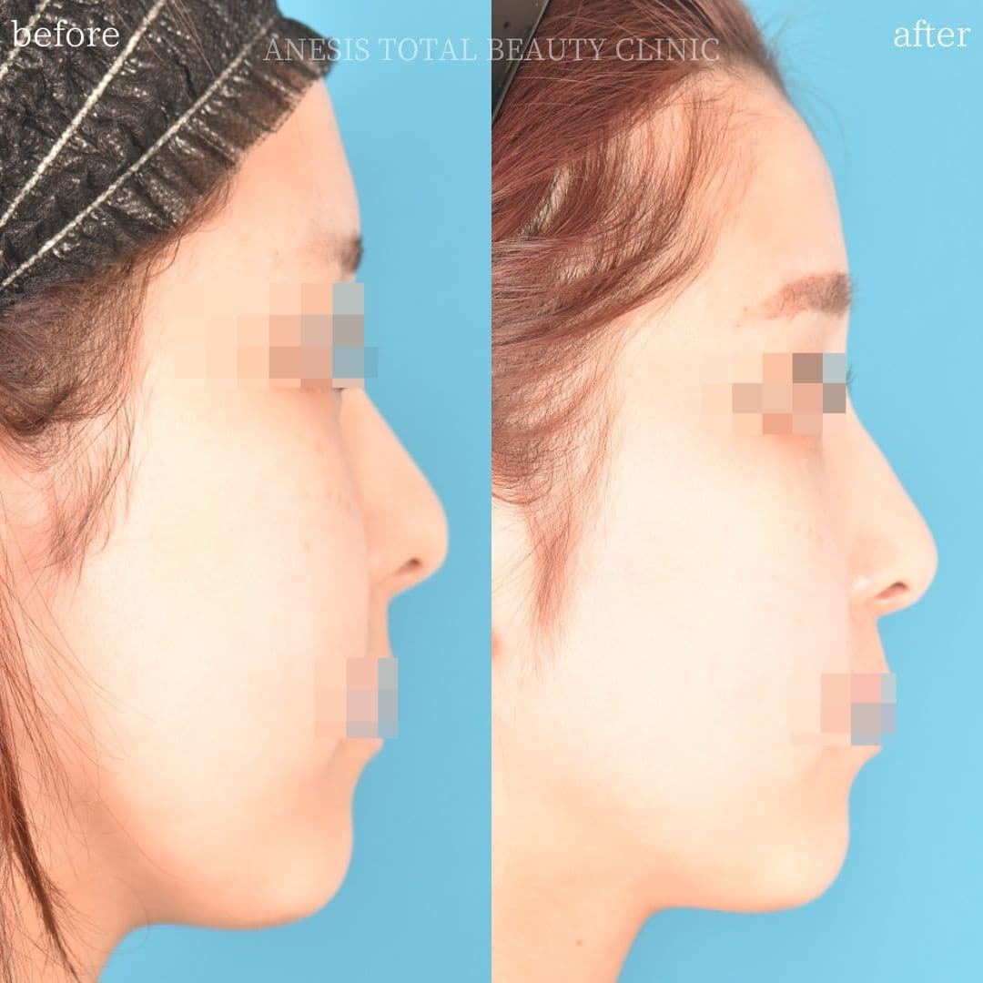 鼻整形ビフォーアフター