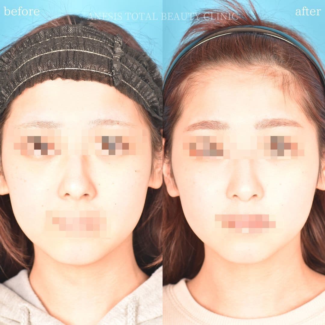 鼻整形ビフォーアフター