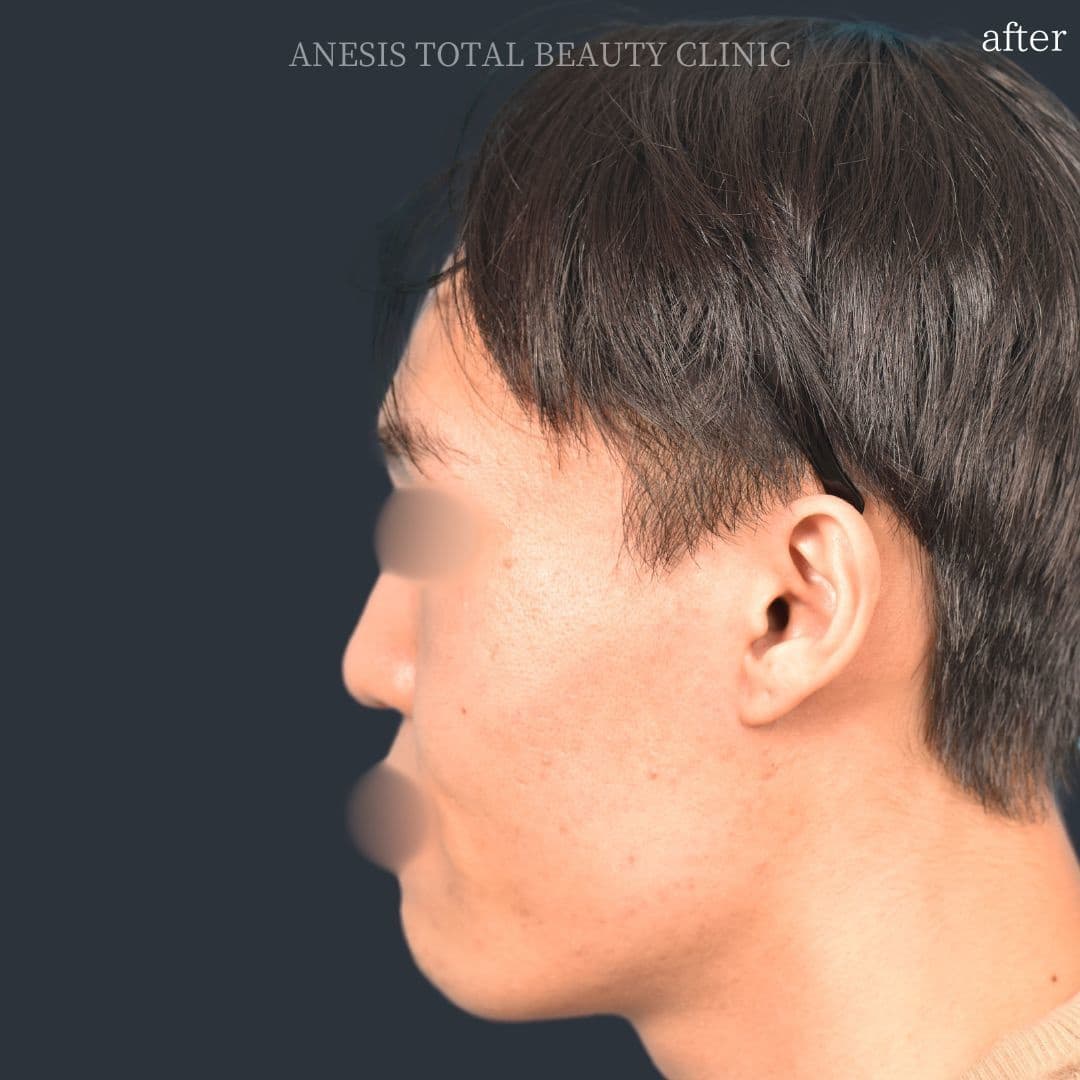 骨切りアフター