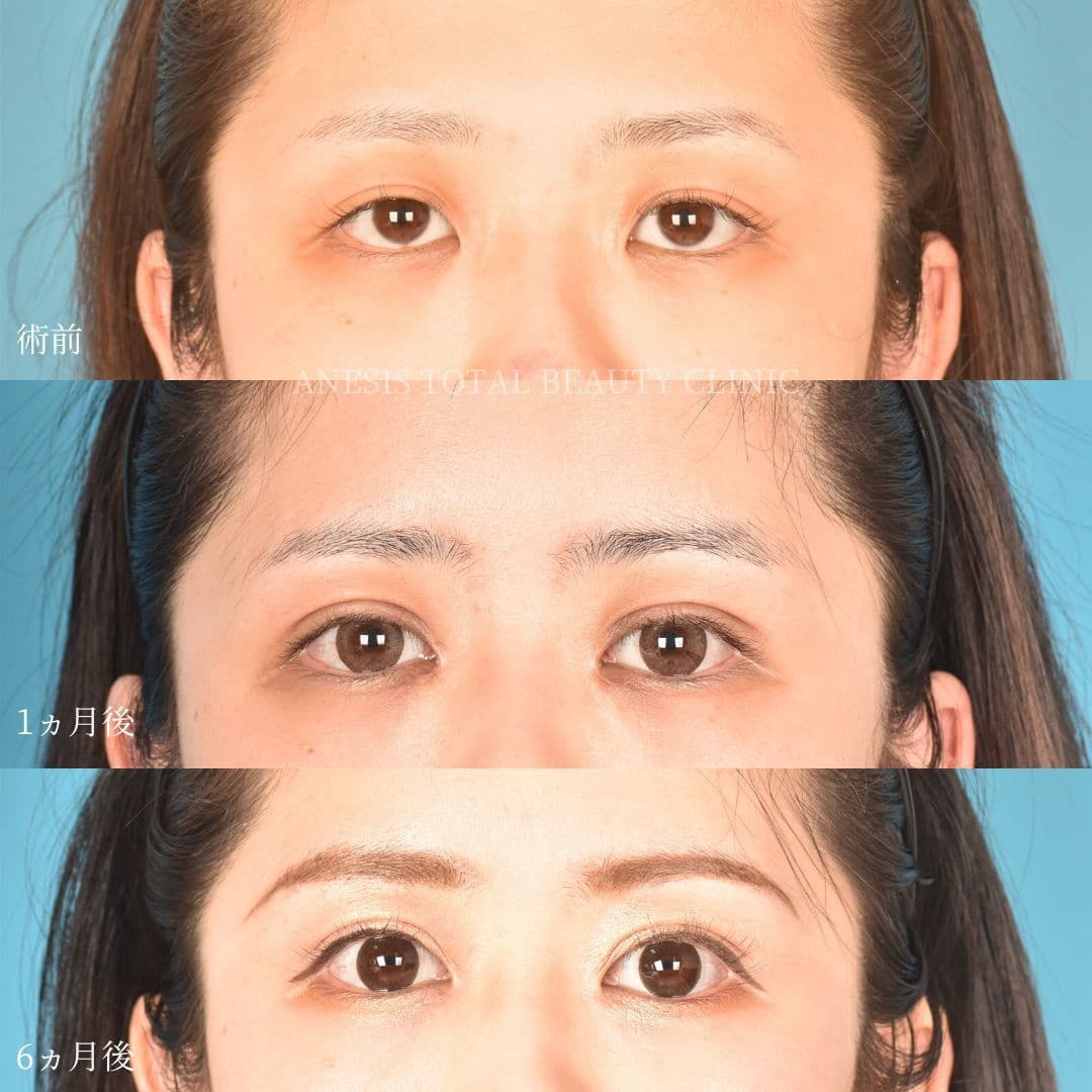 目整形ビフォーアフター