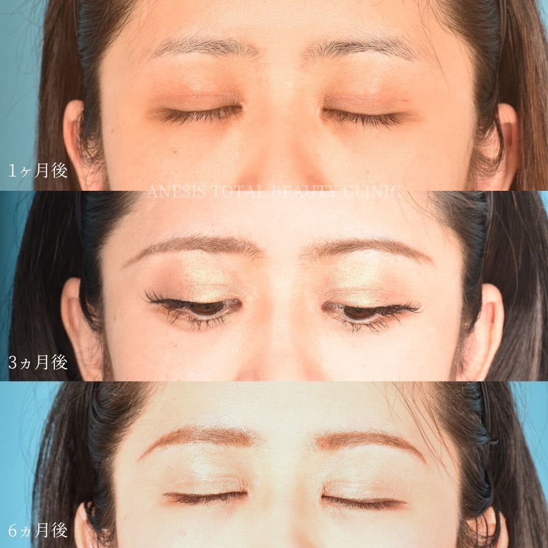 目整形ビフォーアフター