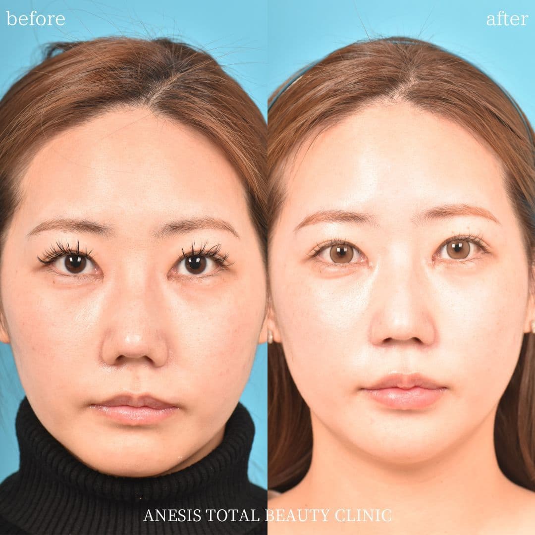 鼻孔縁挙上術ビフォーアフター