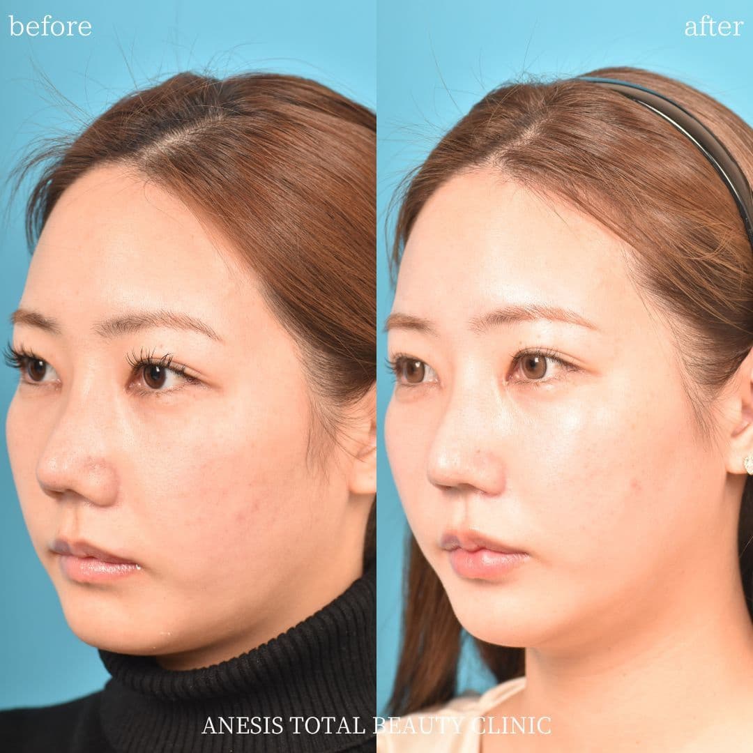 鼻孔縁挙上術ビフォーアフター