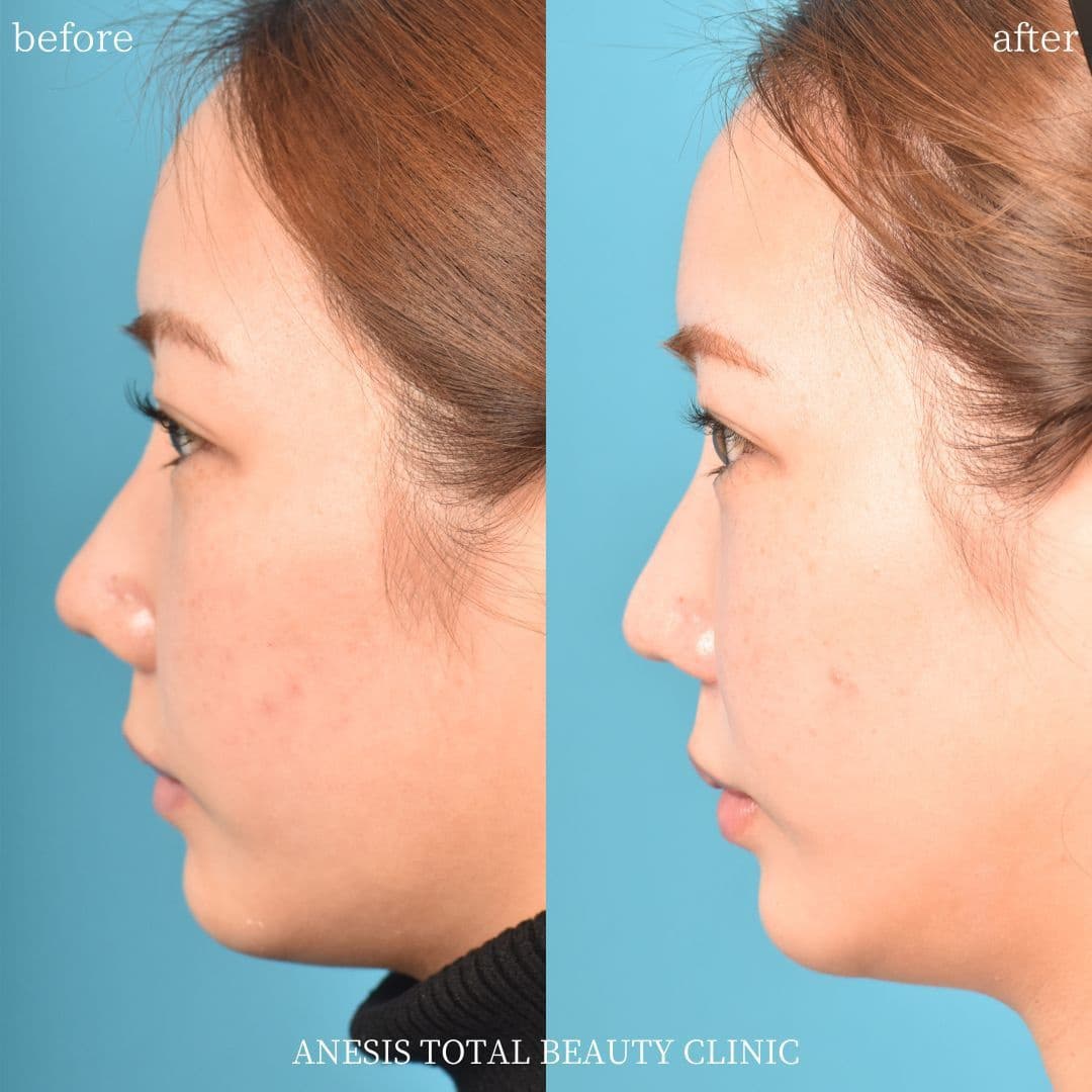 鼻孔縁挙上ビフォーアフター