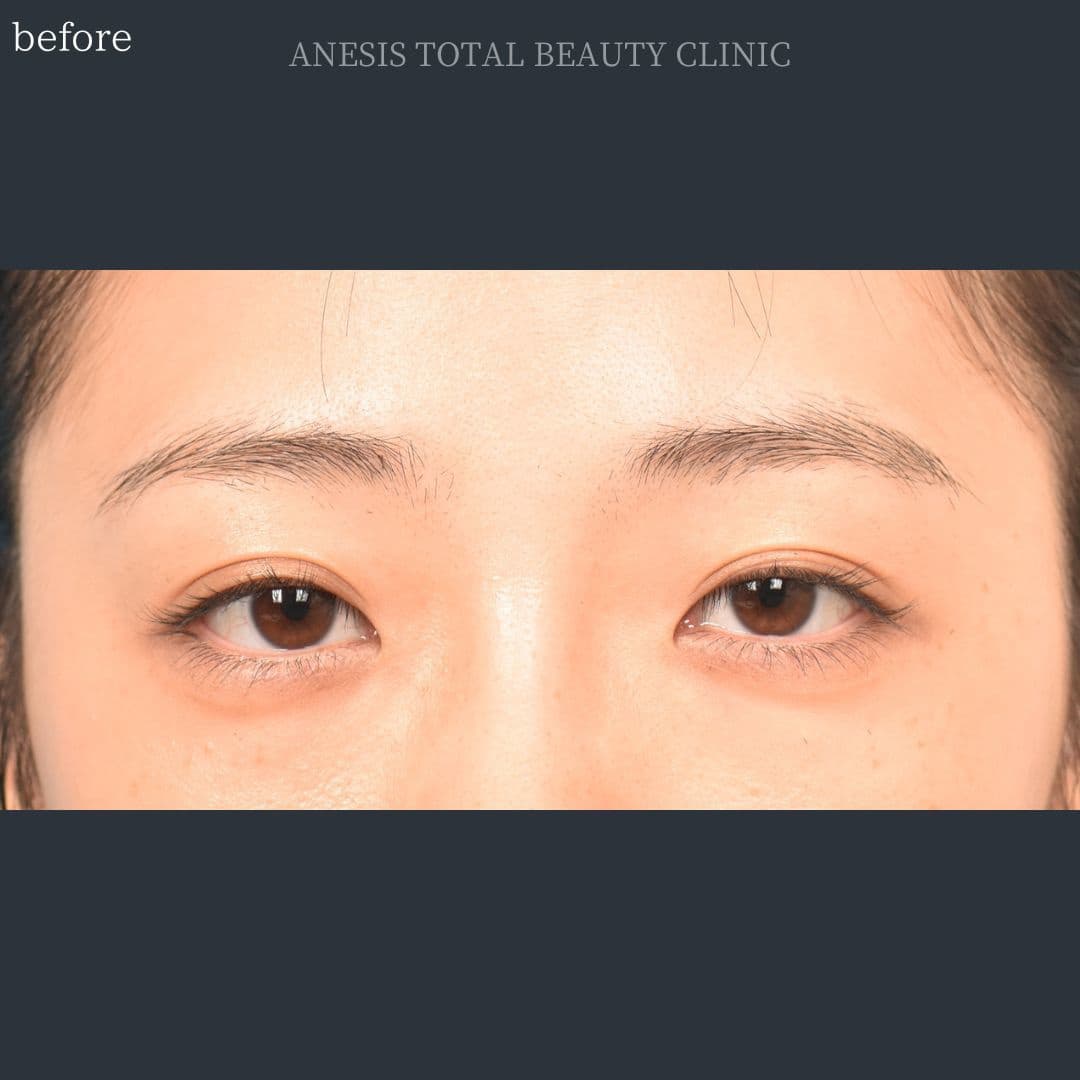 目頭切開ビフォー