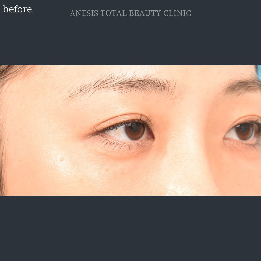 目頭切開ビフォー