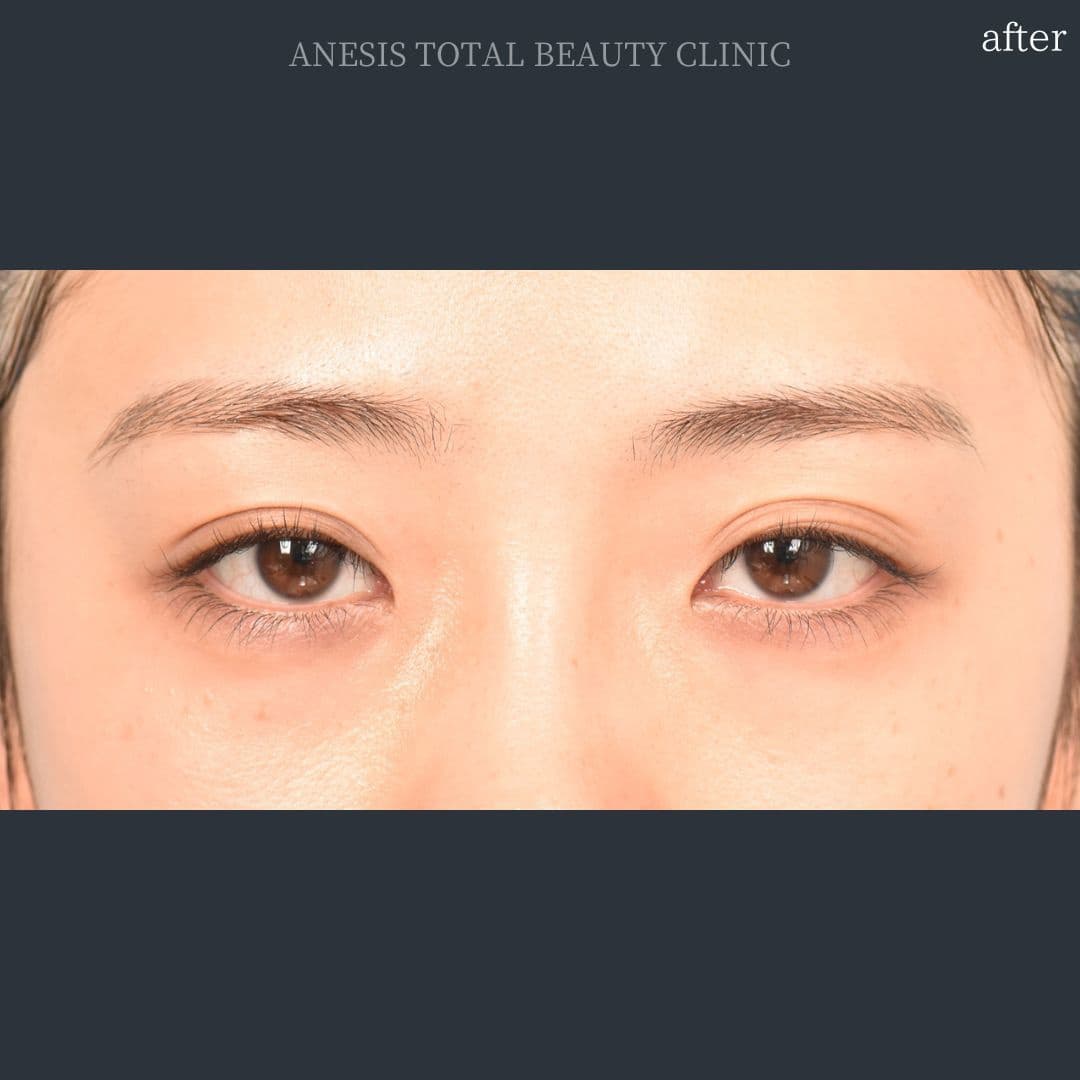 目頭切開アフター