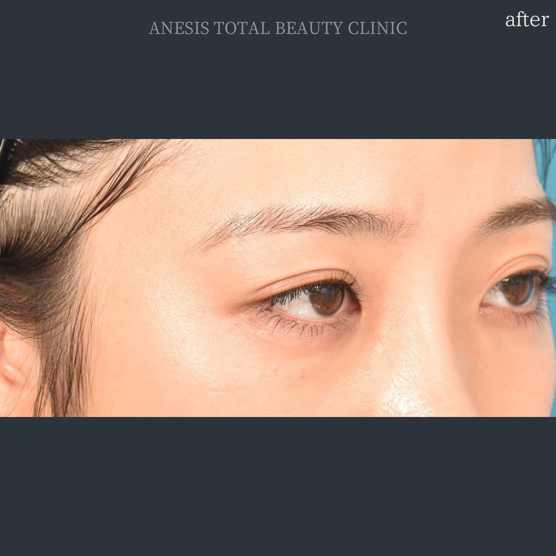 目頭切開アフター