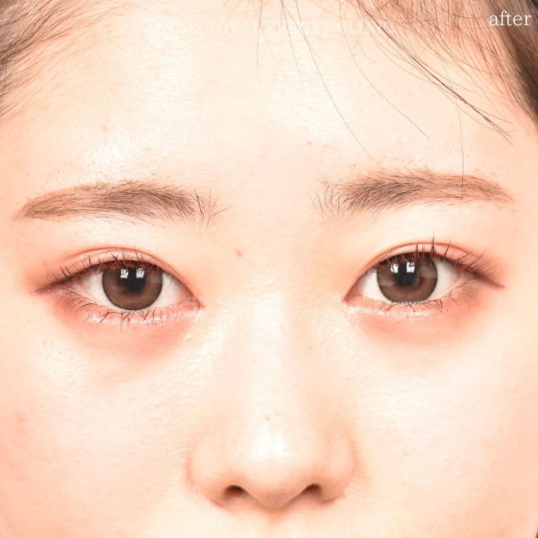 目頭切開アフター