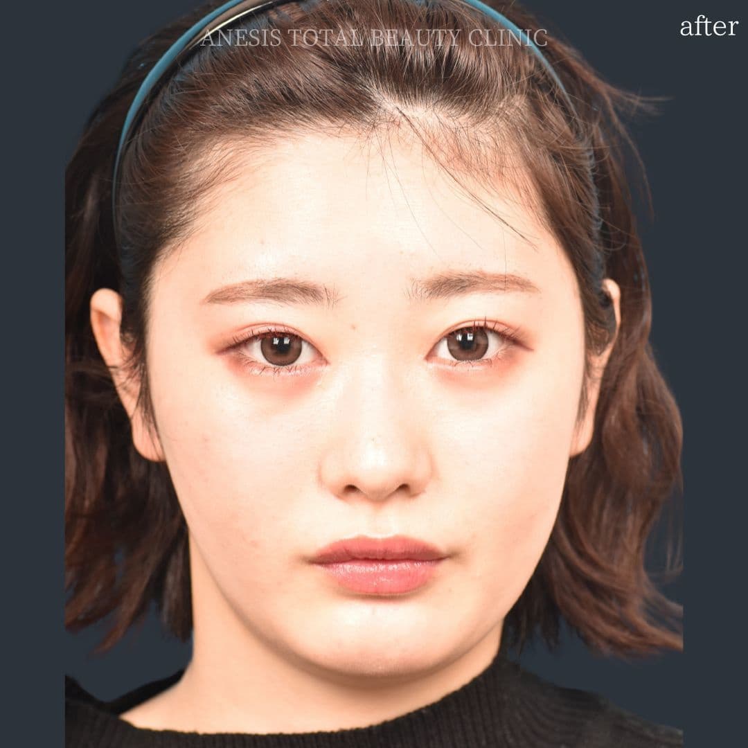 目頭切開アフター