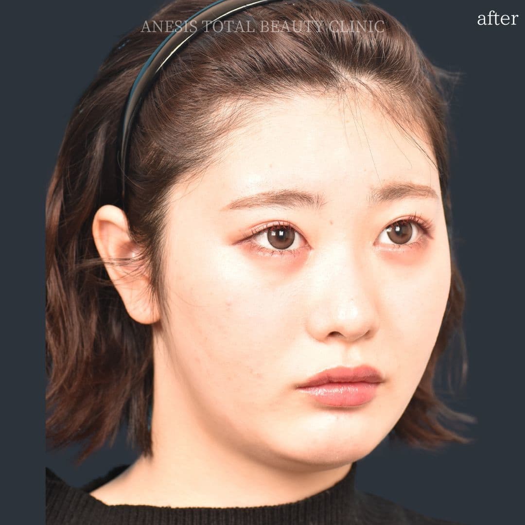 目頭切開アフター