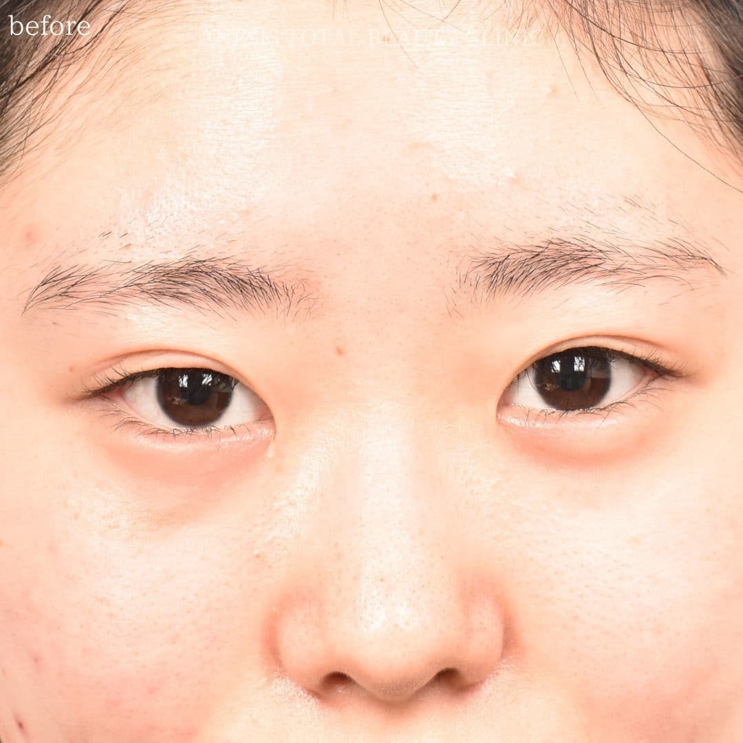 目頭切開ビフォー