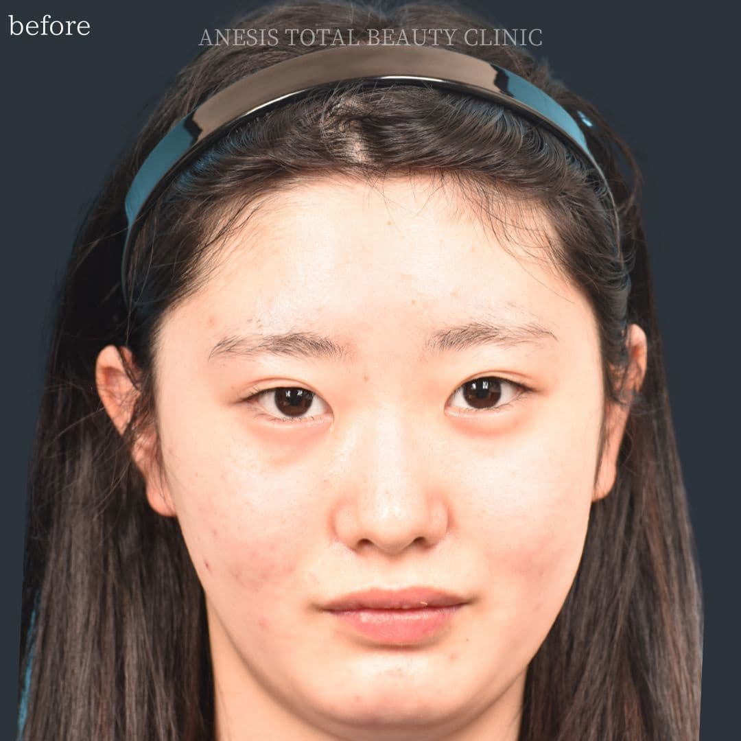 目頭切開ビフォー