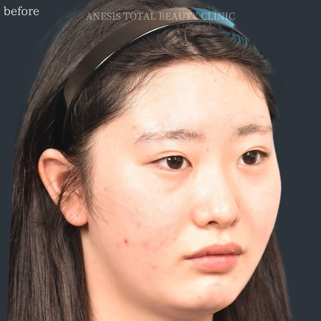 目頭切開ビフォー